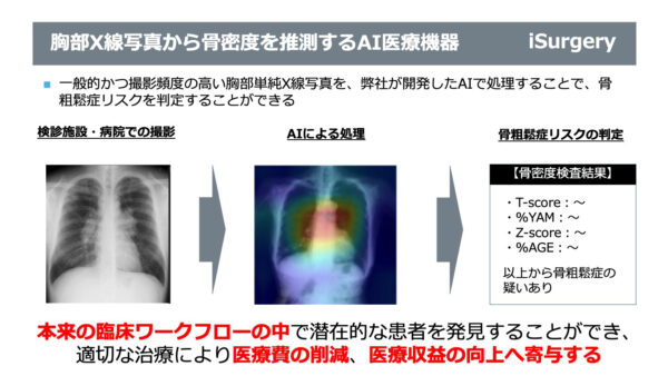 胸部単純X線写真から骨密度を推測するAI医療機器